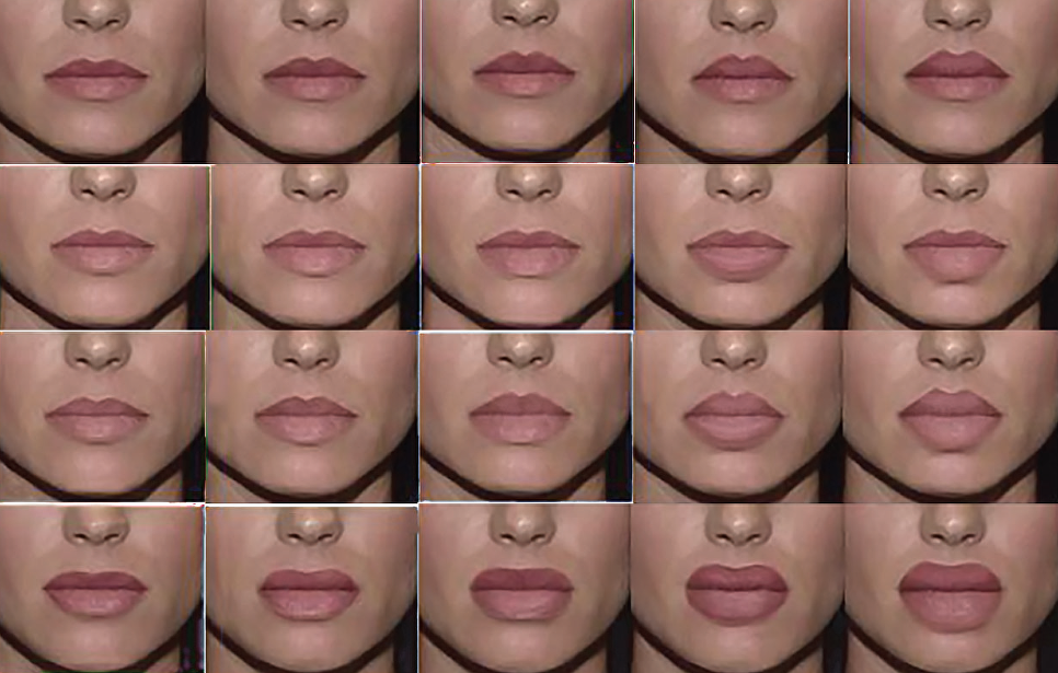 Виды увеличения губ по форме фото и названия